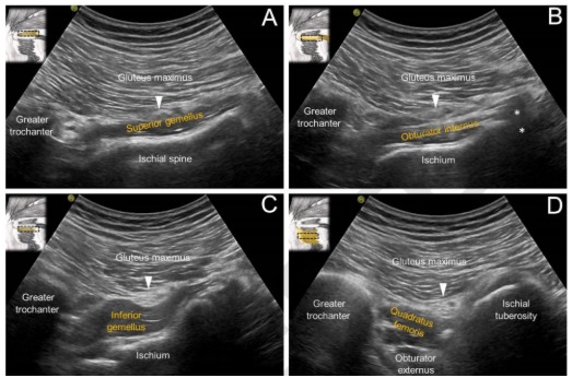 Ecografía del obturador interno, gemelos y cuadrado femoral