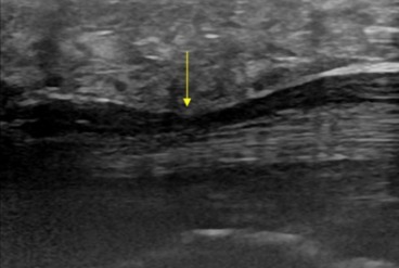 Neuropatías de miembro inferior: exploración ecográfica. Signos ecográficos Neuropatías de miembro inferior: exploración ecográfica. Signos ecográficos