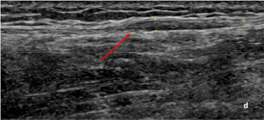Neuropatías de miembro inferior: exploración ecográfica. Ecografia nervio peroneo superficial Neuropatías de miembro inferior: exploración ecográfica. Ecografia nervio peroneo superficial