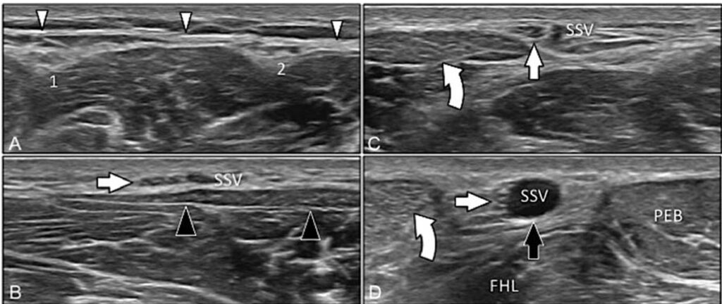 Neuropatías de miembro inferior: exploración ecográfica Neuropatías de miembro inferior: exploración ecográfica