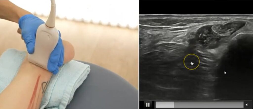 Neuropatías de miembro inferior: exploración ecográfica. Ecografia nervio tibial antes de división Neuropatías de miembro inferior: exploración ecográfica. Ecografia nervio tibial antes de división