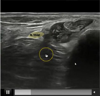 Neuropatías de miembro inferior: exploración ecográfica. Ecografia nervio tibial antes de división - señalado Neuropatías de miembro inferior: exploración ecográfica. Ecografia nervio tibial antes de división - señalado