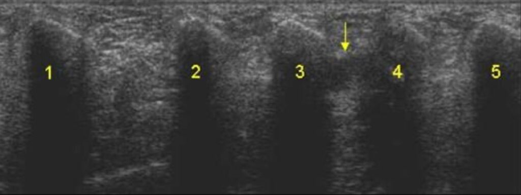 Ecografia de neuroma de Morton