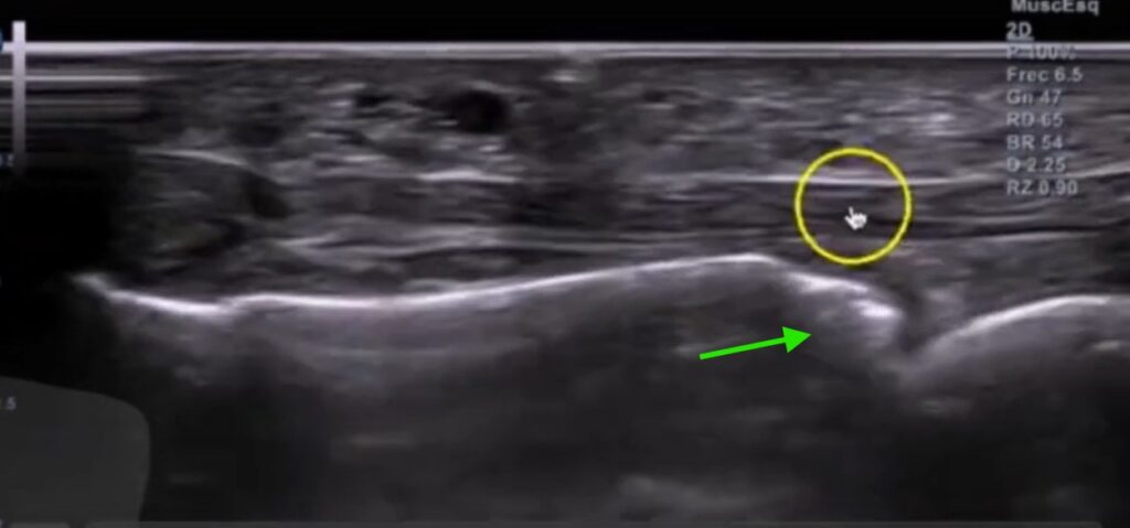 Enfermedad de Freiberg en fisioterapia. Convexidad metatarsiano