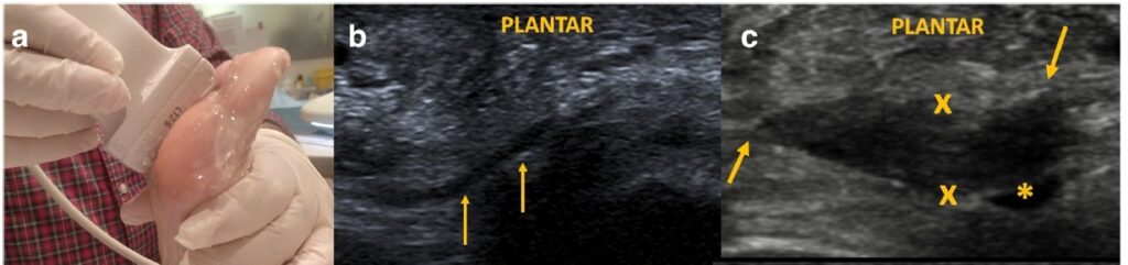 Ecografia con abordaje plantar neuroma de Morton - corte longitudinal