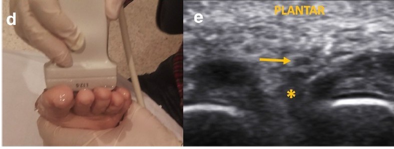 Ecografia con abordaje plantar neuroma de Morton - corte transversal d y e