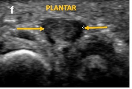 Ecografia con abordaje plantar neuroma de Morton - corte transversal f