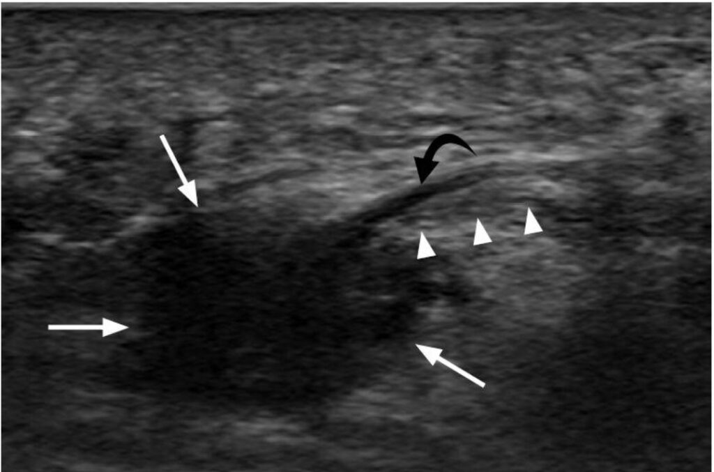 Ecografia longitudinal neuroma de Morton