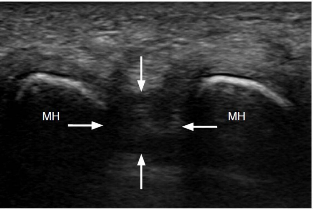 Ecografia transversal neuroma de Morton