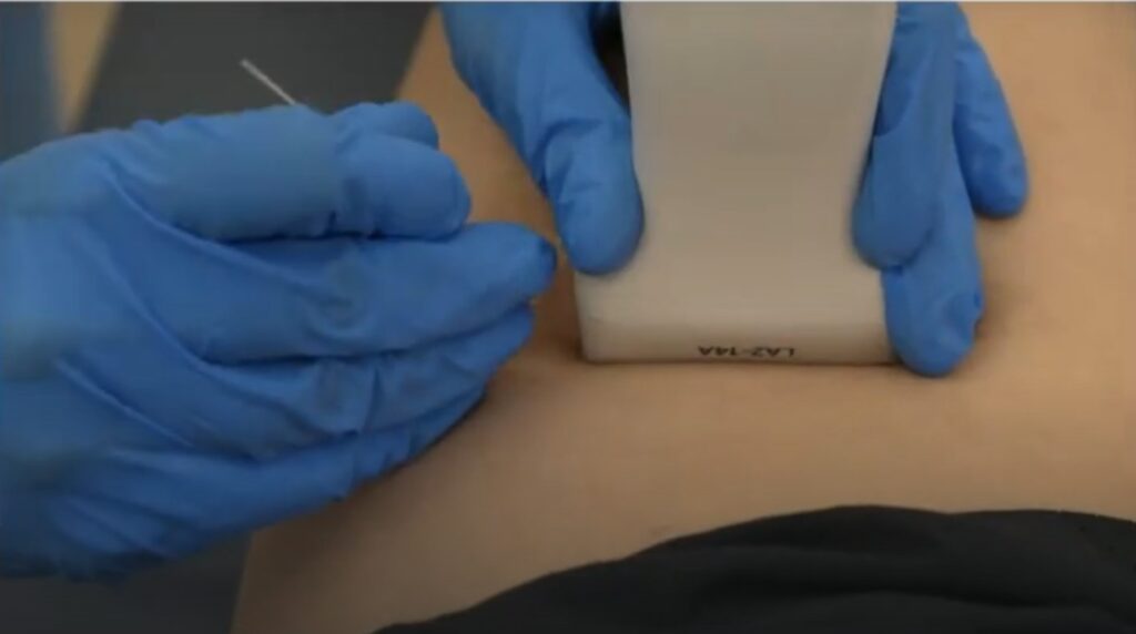 Abordaje PENS en dolor ciatico