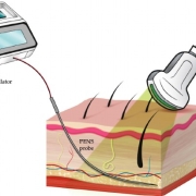 PENS en dolor neuropatico