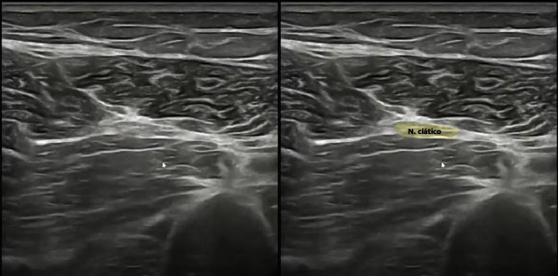 PENS en dolor neuropatico - nervio ciatico señalado