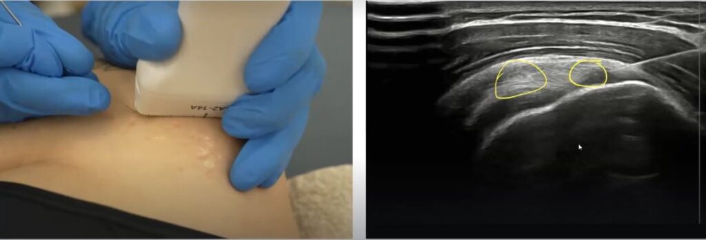 Electrólisis percutánea en tendón supraespinoso. Abordaje con electrolisis en rotura del supraespinoso