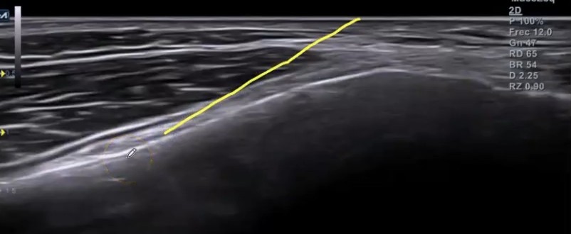 Abordaje invasivo PENS. Electroestimulación percutánea en artrosis de rodilla