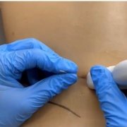 Neuroestimulación percutánea (PENS) y dolor lumbar crónico