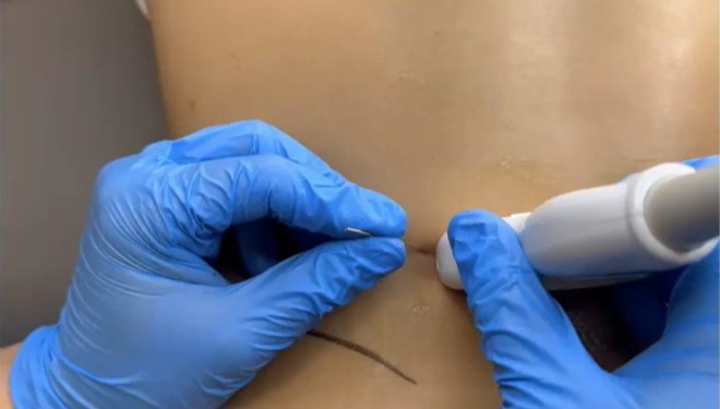 Neuroestimulación percutánea (PENS) y dolor lumbar crónico