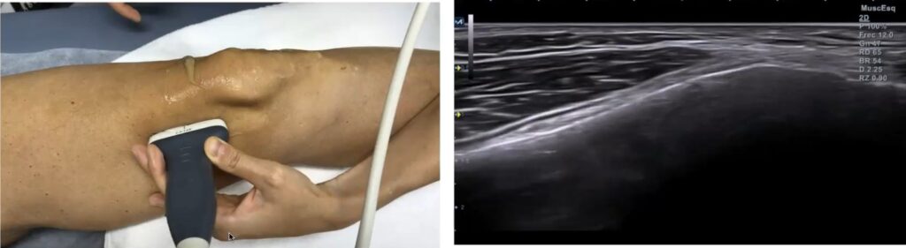 Imagen ecográfica ramo geniculado medial superior. Electroestimulación percutánea