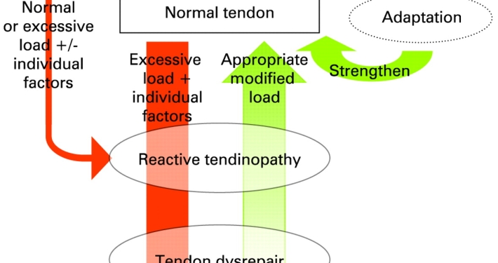 Electrólisis percutánea en tendón supraespinoso: técnica efectiva para tratar tendinopatías crónicas y mejorar la función del hombro.