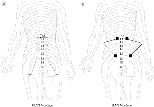 Posicionamiento agujas PENS dolor lumbar cronico