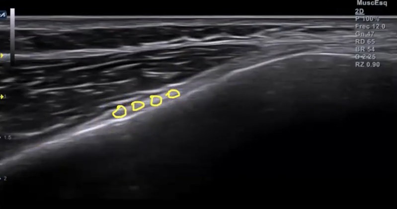 Ramo geniculado medial superior señalado ecografía. Electroestimulación percutánea en artrosis de rodilla