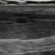 Imagen ecografica longitudinal de tendinopatia cronica tendon Aquiles