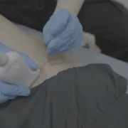 abordaje PENS en dolor cronico postquirurgico – nervio femoral