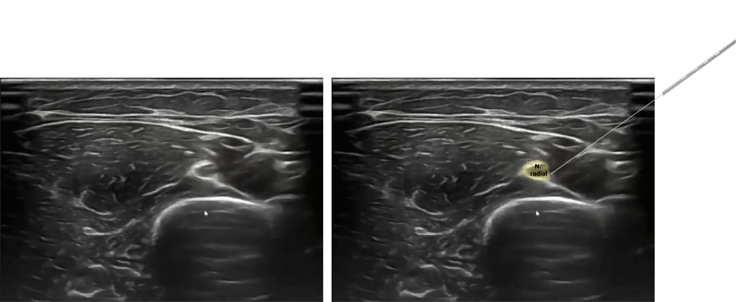 Fisioterapia invasiva en epicondilalgia lateral. Electroestimulación percutánea en nervio radial para epicondilalgia Imagen ecográfica del abordaje de estimulación eléctrica percutánea en nervio radial para epicondilitis