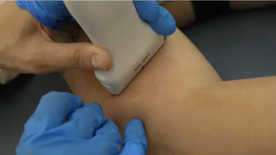 Fisioterapia invasiva en epicondilalgia lateral. Aplicación de PENS en nervio radial Abordaje de fisioterapia invasiva en epicondilalgia lateral