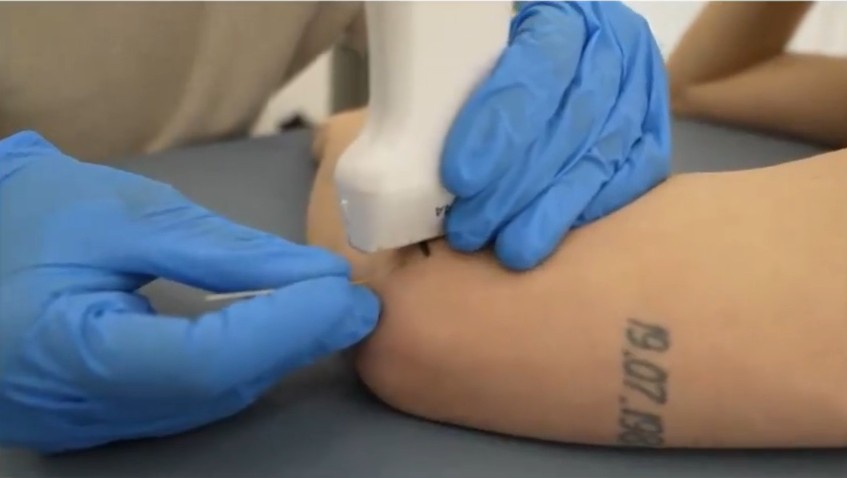 Abordaje de electrólisis percutánea en epicondilalgia abordaje invasivo por la cara posterior del codo para la aplicación de electrólisis percutánea en epicondilitis