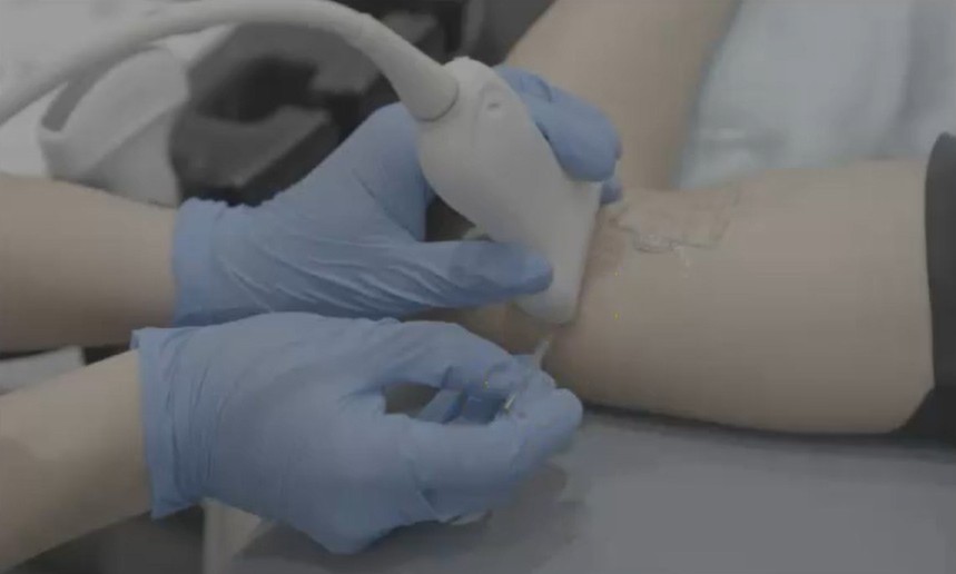aplicación de PENS en el nervio cubital en consulta de epicondilitis: caso de dolor neuropático intervención ecoguiada de una aguja para aplicar PENS en el nervio cubital