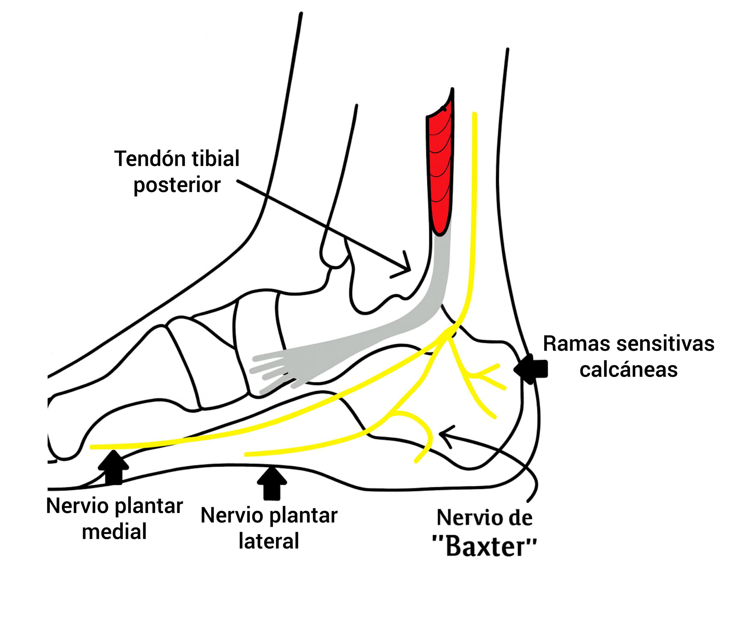 Esquema de la division del nervio tibial posterior que posteriormente trataremos con estimulación eléctrica percutánea (PENS) imagen esquematica de la division del nervio tibial posterior