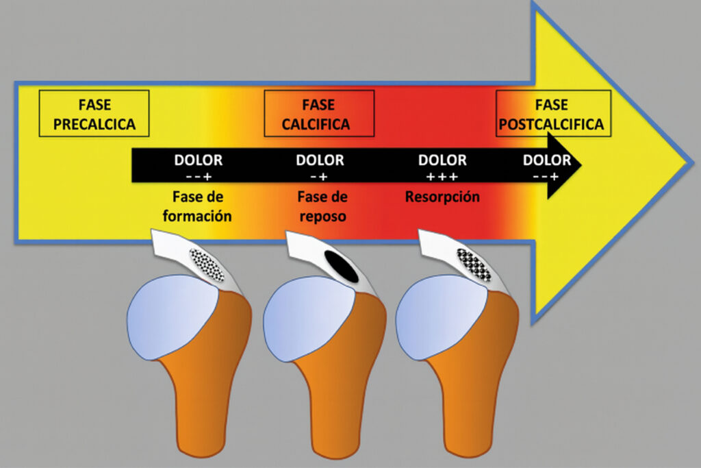 fases de una calcificación tendinosa: precalcica, calficica, reabsorción y postcalcifica con diferencias en dolor fases de una calcificación tendinosa