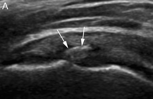 Tendinitis calcificante del supraespinoso: imagen ecográfica Así se ve una tendinitis calcificante del supraespinoso en ecografía