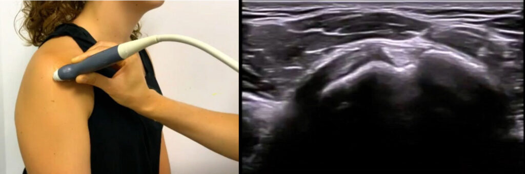 ecografía longitudinal del tendón subescapular y posicionamiento de la sonda ecográfica