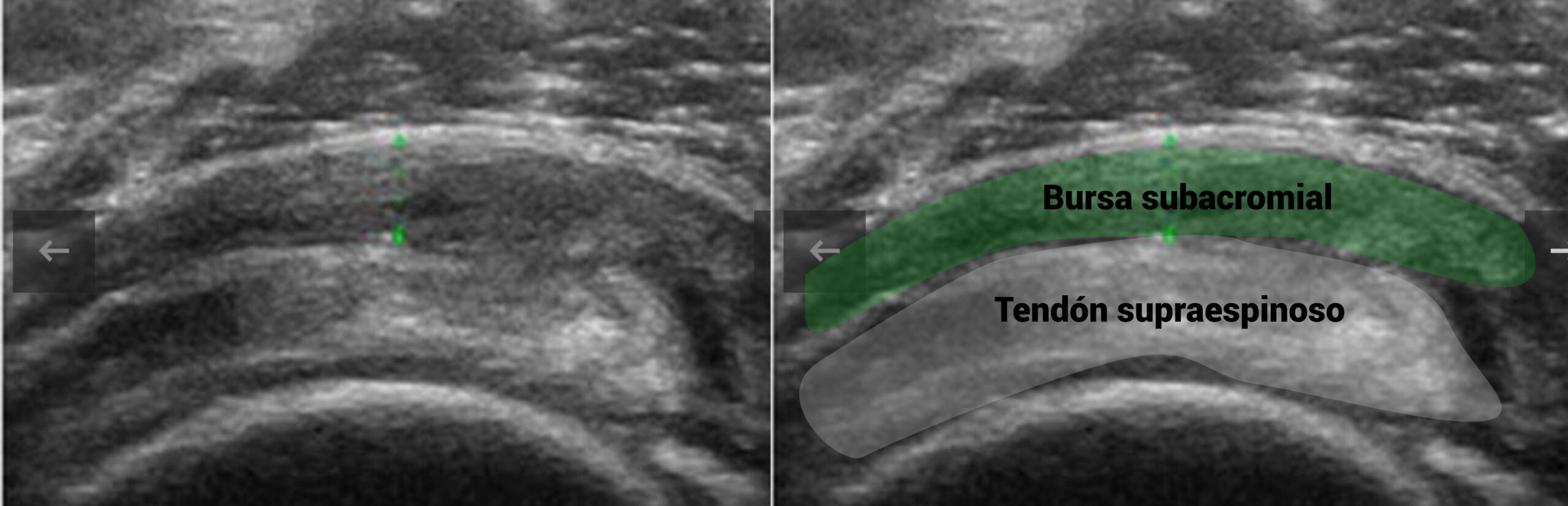Imagen ecográfica de una bursitis subacromial Imagen ecográfica de una bursitis subacromial