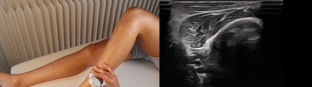 ecografía región tibial anterior no patológica Imagen ecográfica de la región tibial anterior en paciente sano