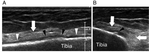 ecografía de una fractura tibial Imagen ecográfica de una fractura tibial en corredor 28 años