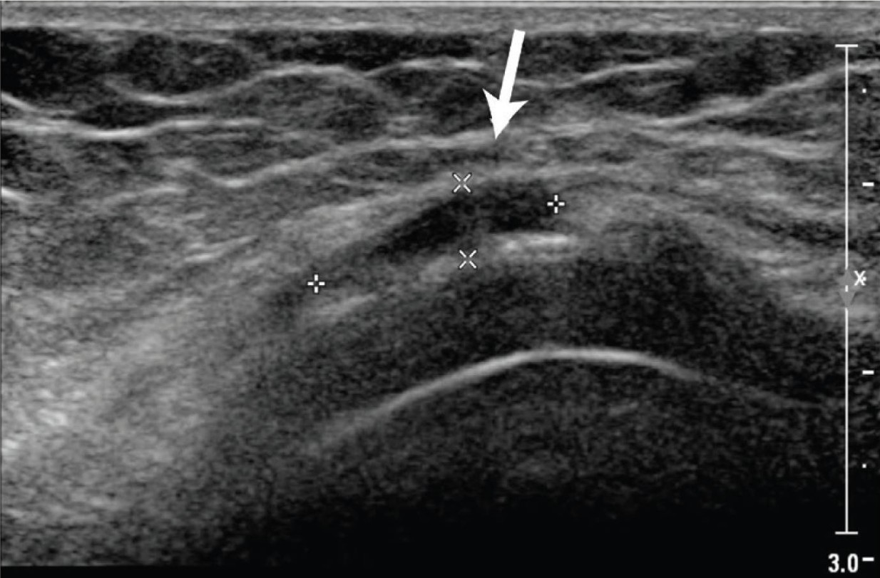 Ecografía de bursitis anserina y tendinitis de la pata de ganso