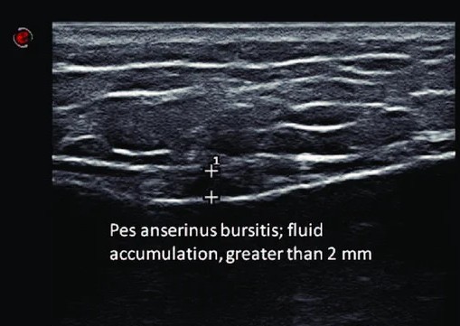 Ecografía de bursitis anserina