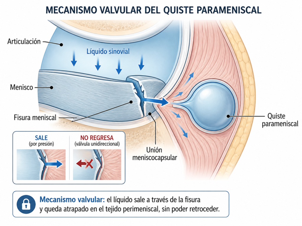 mecanismo valvular que explica el origen de la formación de un quiste parameniscal