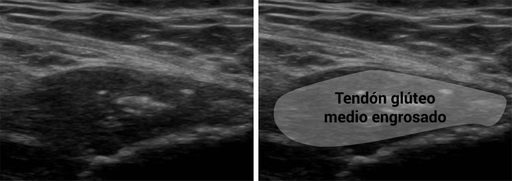 Ecografía de tendinopatía insercional gluteo medio
