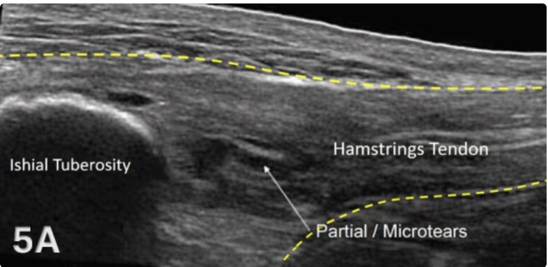 imagen ecográfica tendinitis proximal isquiotibiales imagen ecográfica tendinitis proximal isquiotibiales
